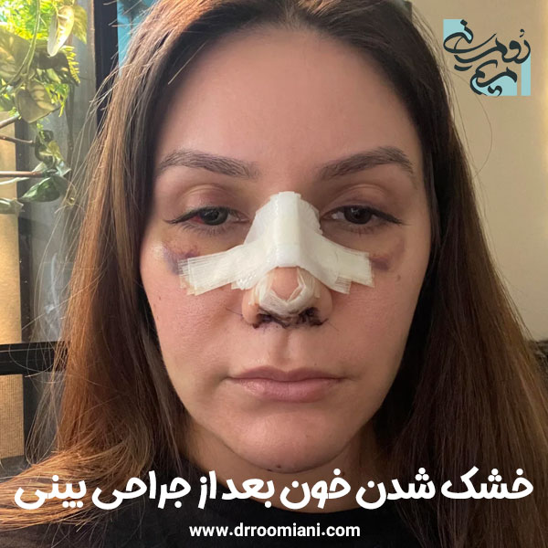 خشک شدن خون بعد از جراحی زیبایی بینی + دکتر مریم رومیانی