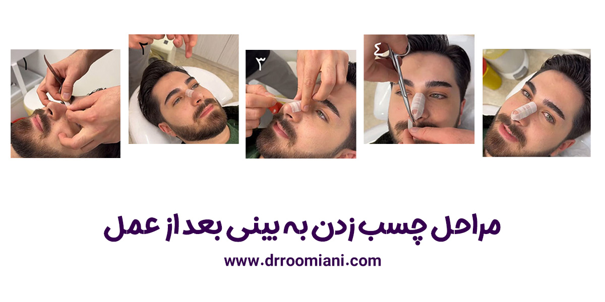 چسب زدن به بینی + دکتر مریم رومیانی