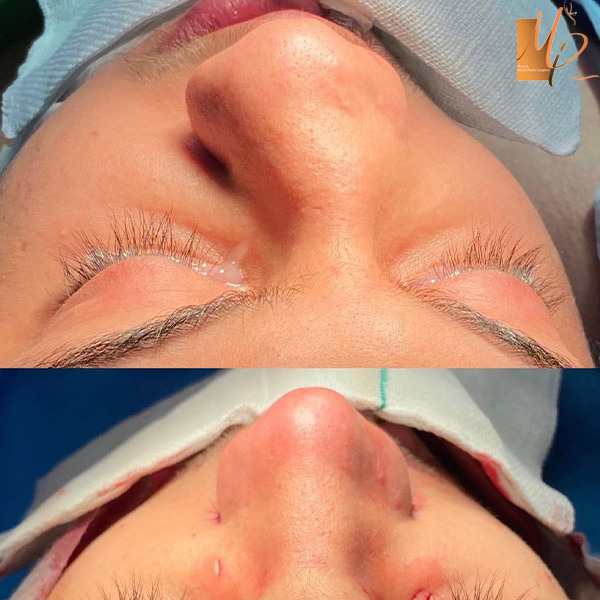 جراحی بینی شکسته - دکتر مریم رومیانی