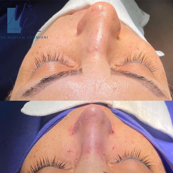 جراحی بینی شکسته - دکتر مریم رومیانی