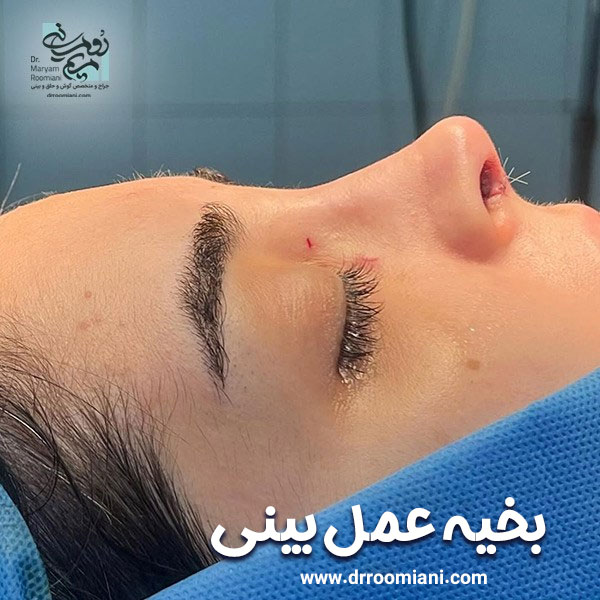 بخیه عمل بینی + دکتر مریم رومیانی