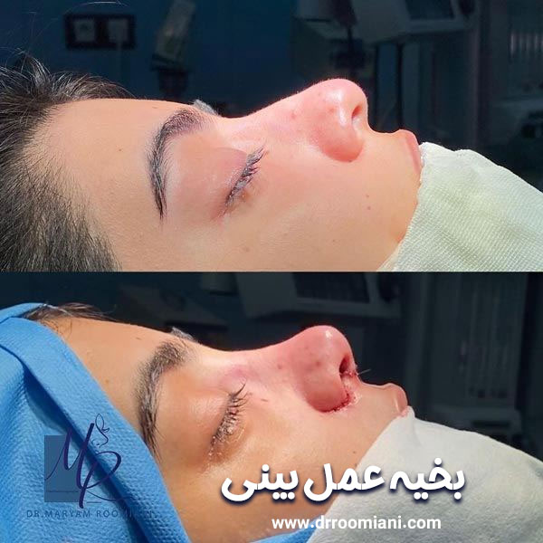 بخیه عمل بینی + دکتر مریم رومیانی