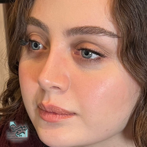 جراحی بینی طبیعی + دکتر مریم رومیانی