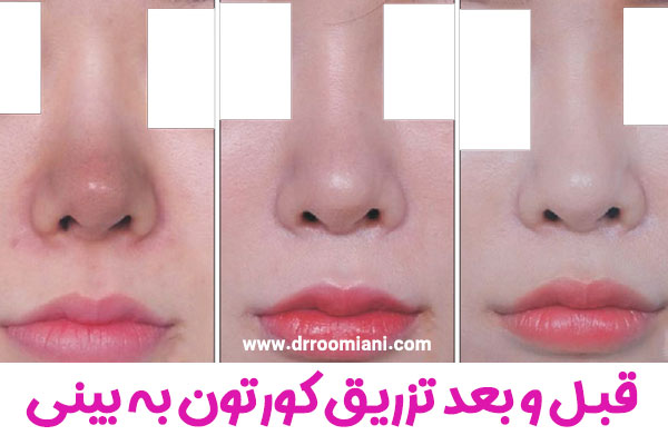 تزریق کورتون به بینی بعد از جراحی + دکتر مریم رومیانی