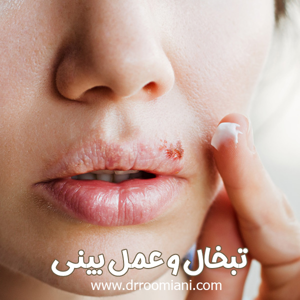 تبخال و عمل بینی + دکتر مریم رومیانی