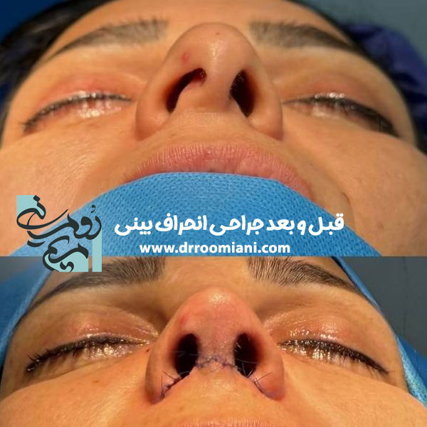 جراحی انحراف بینی + دکتر مریم رومیانی