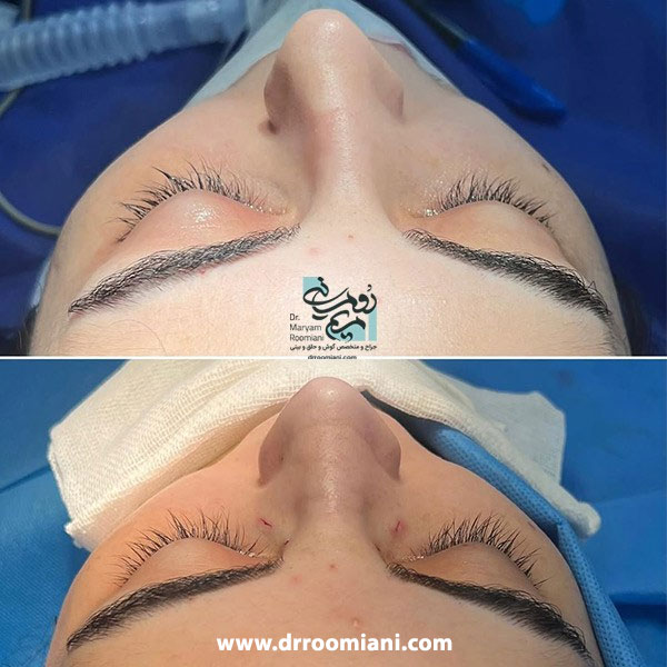 جراحی انحراف بینی + دکتر مریم رومیانی