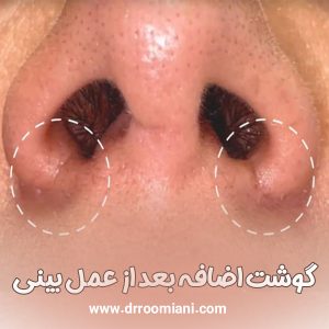گوشت اضافه بعد از عمل بینی + دکتر مریم رومیانی