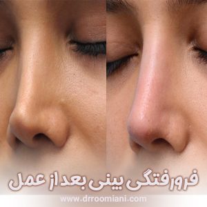 فرورفتگی بینی بعد از عمل + دکتر مریم رومیانی