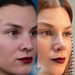 جراحی بینی گوشتی + دکتر مریم رومیانی