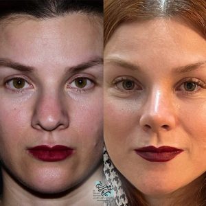 جراحی بینی گوشتی + دکتر مریم رومیانی