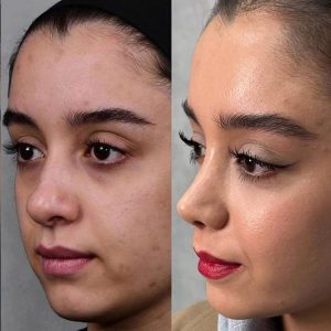 جراحی بینی گوشتی + دکتر مریم رومیانی