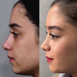 جراحی بینی گوشتی + دکتر مریم رومیانی