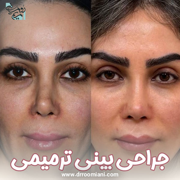 تصاویر قبل و بعد عمل بینی ترمیمی + دکتر رومیانی