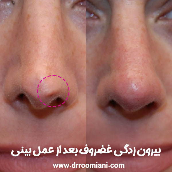 بیرون زدگی غضروف بعد از عمل بینی + دکتر مریم رومیانی