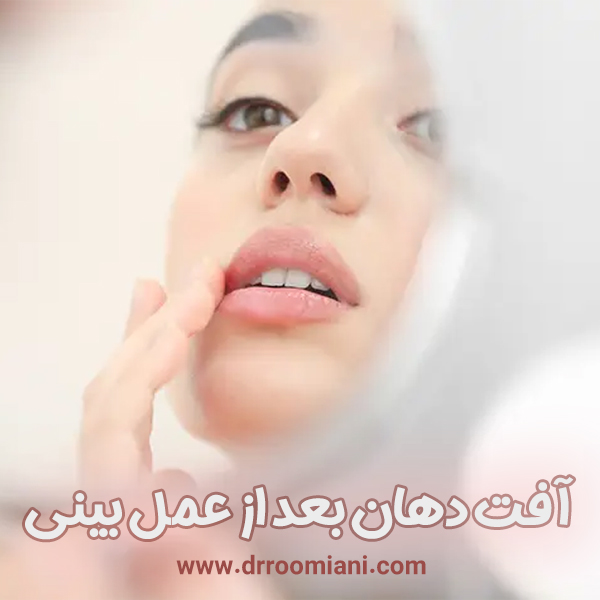 آفت دهان بعد از عمل بینی + دکتر مریم رومیانی