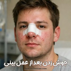 جوش زدن بعد از عمل بینی + دکتر مریم رومیانی