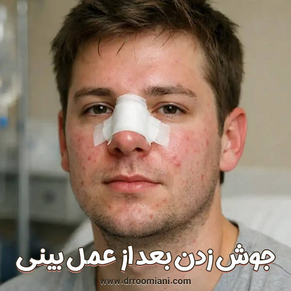 جوش زدن بعد از عمل بینی + دکتر مریم رومیانی