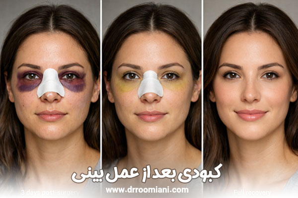 کبودی بعد از عمل بینی + دکتر مریم رومیانی