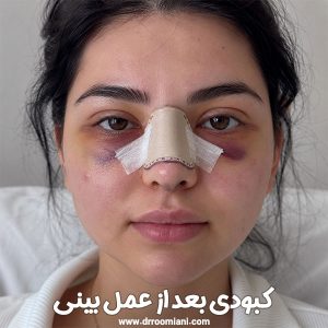 کبودی بعد از عمل بینی + دکتر مریم رومیانی